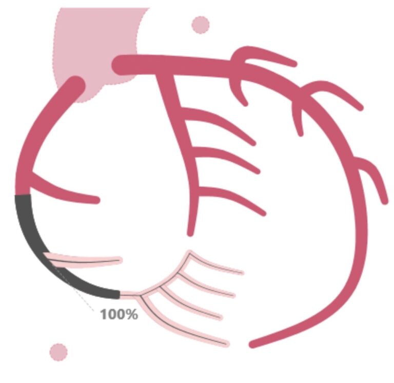 A diagram of arterial lesion and stent placement